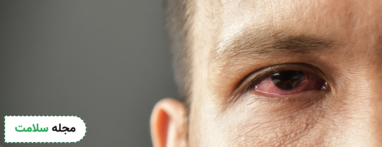 pink eye