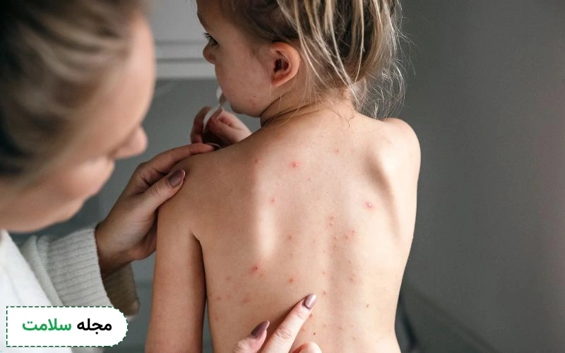 ممکن است همزمان آبله مرغان و واکنش آلرژیک داشته باشم؟