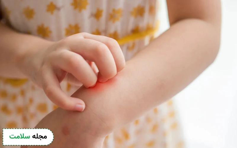 تفاوت ابله مرغان با حساسیت چیست؟