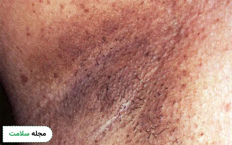 علائم بیماری نوروفیبروماتوز چگونه بروز می کند؟