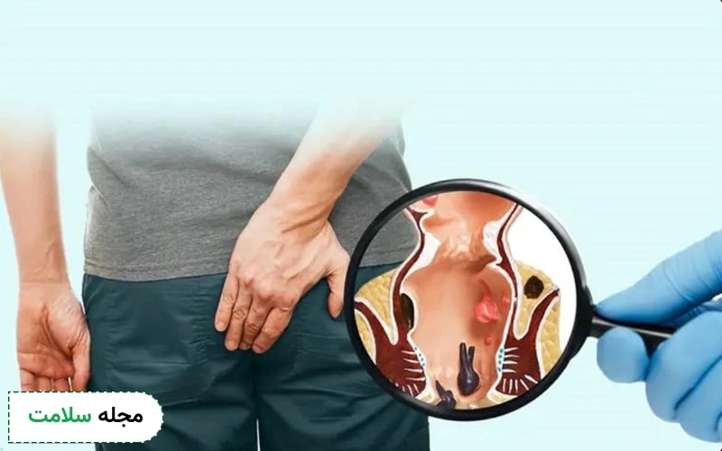 فیستول مویی چیست؟
