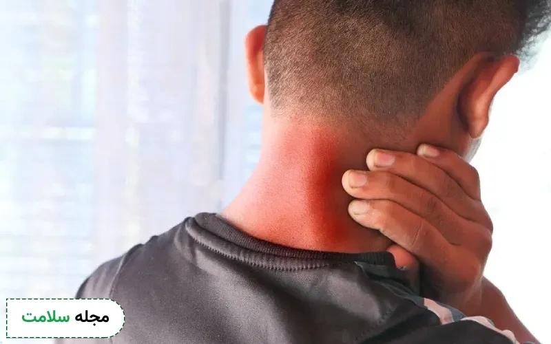کدام دارو برای کیست گردن موثر است؟