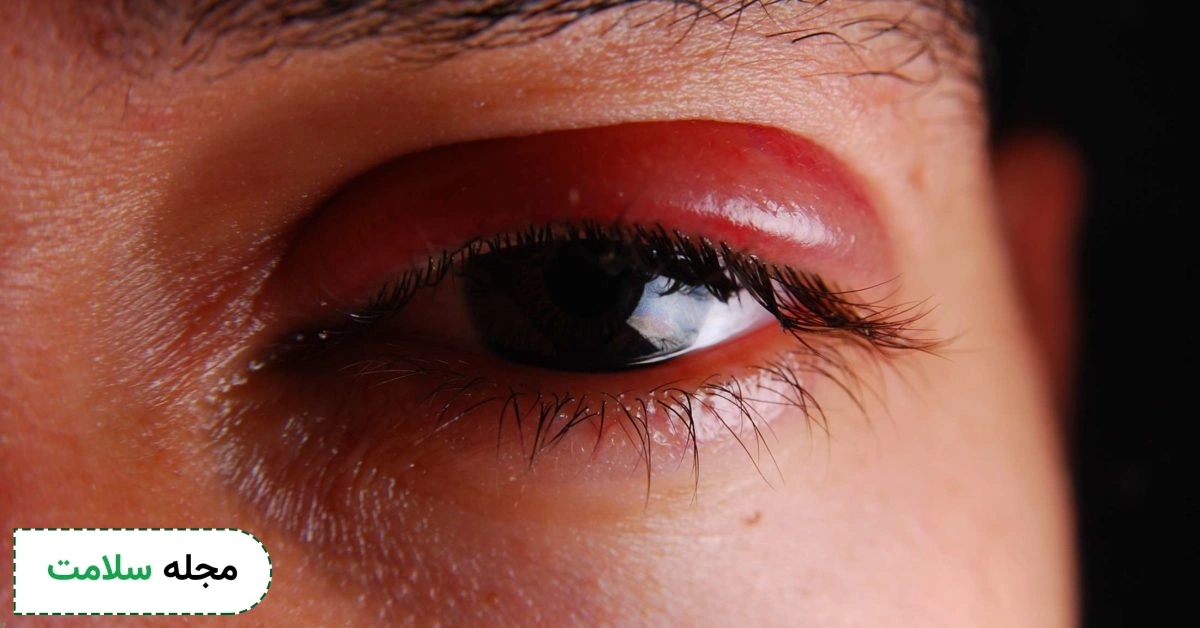 stye eye