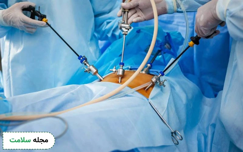 عمل جراحی کیست تخمدان چگونه است؟