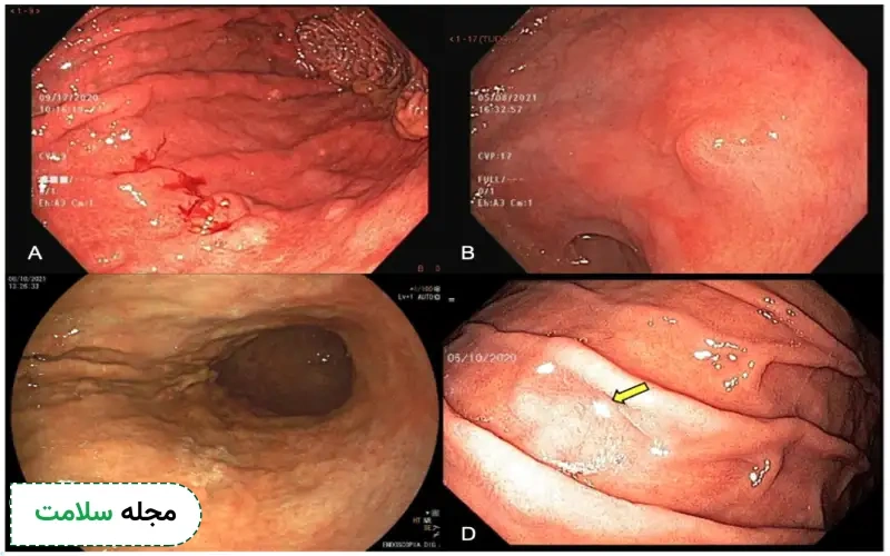 عکس آندوسکوپی سرطان معده خوش خیم بدین شکل است.