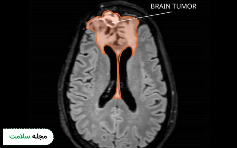 عکس MRI تومور مغزی بدخیم چگونه است؟