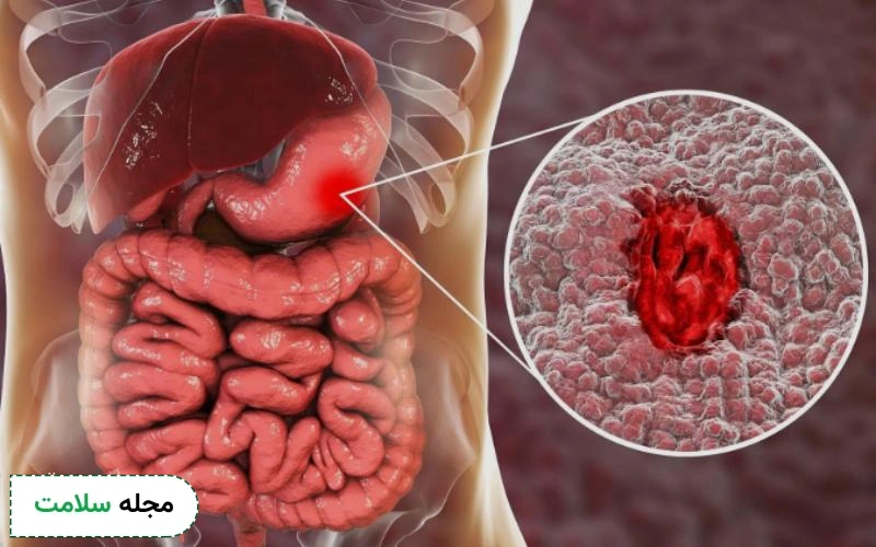 انواع خونریزی دستگاه گوارش چه علت و راه درمانی دارد؟