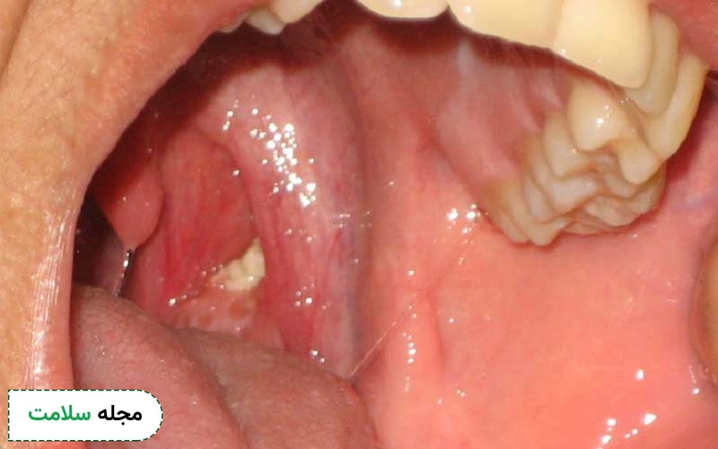سنگ لوزه تودههای کوچک و سفتی هستند.