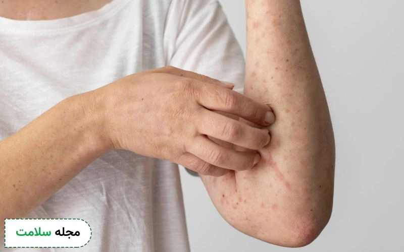 چگونه میتوان خارش شدید جوش ها را کاهش داد؟