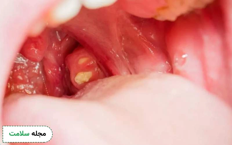 سنگ لوزه چه تفاوتی با سرطان لوزه دارد؟