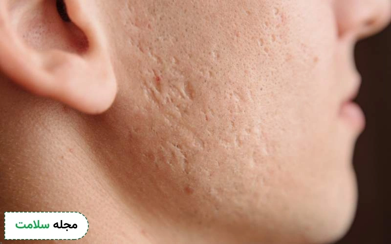 علت ماندن جای آبلهمرغان چیست؟