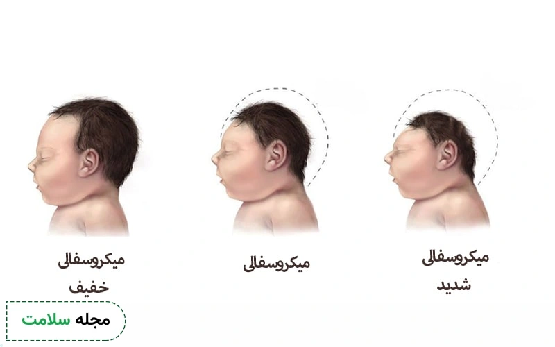 انواع میکروسفالی وجود دارد.