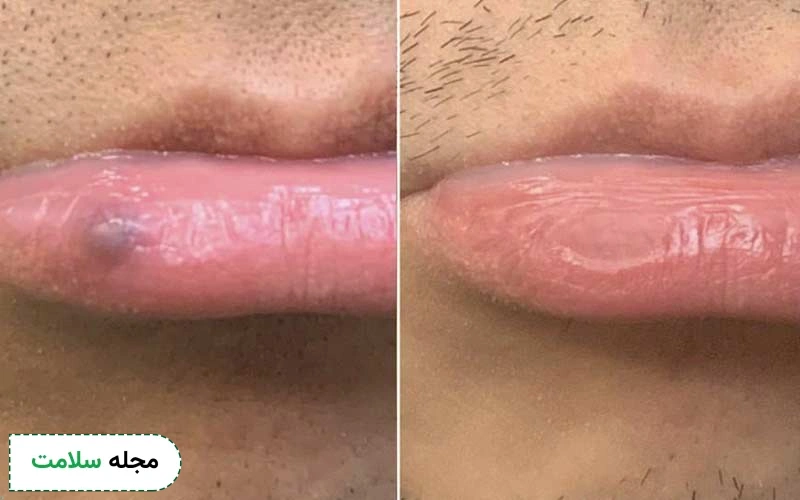 چگونه کبودی لب برطرف می‌شود؟