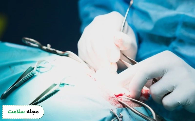 جراحی برای آسیب عصب سیاتیک در اثر تزریق ممکن است استفاده شود.