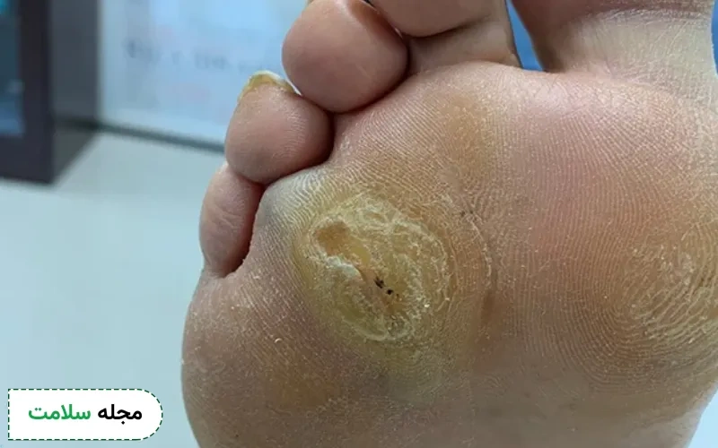 اصول کلی مراقبت از زخم پای دیابتی در خانه چگونه است؟