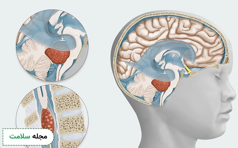 طول عمر بیماران تومور مغزی گرید 4 چقدر است؟