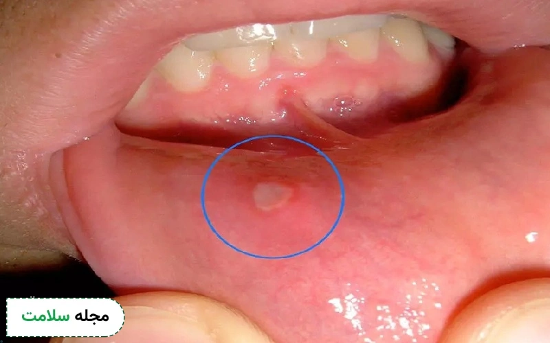 آفت زخم داخل دهان