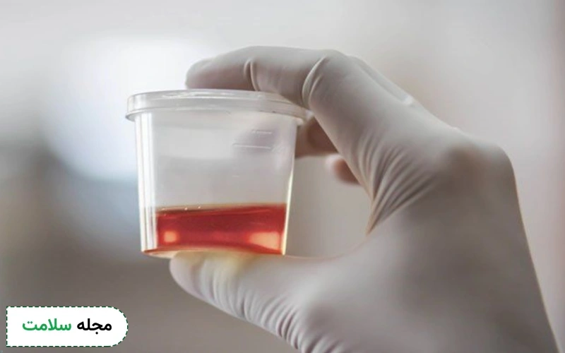 خون در ادرار یا ادرار خونی (Hematuria)؛ علت و روش درمان آن