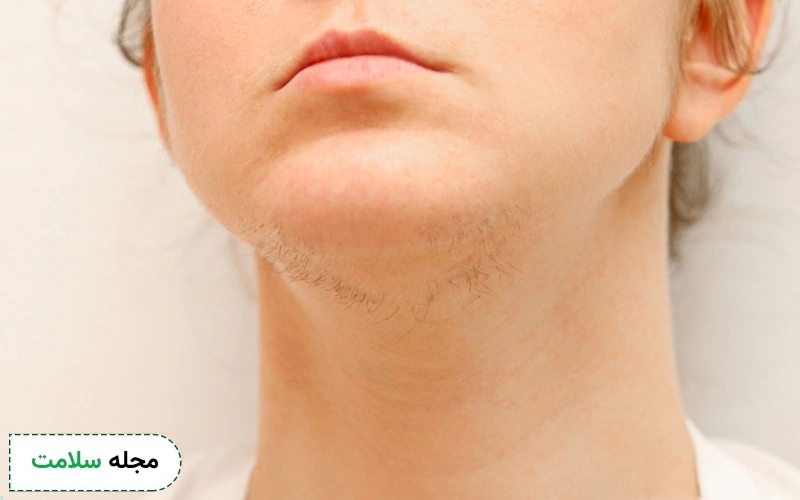 علت موهای زائد زیر چانه و دور سینه زنان چیست؟