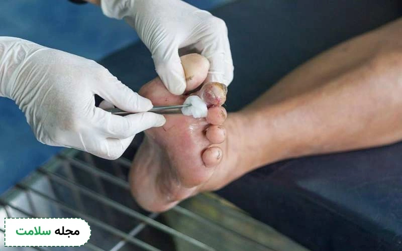 نحوه پانسمان زخم دیابتی این گونه است.