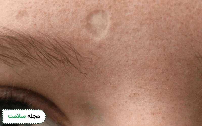 چرا اسکار ابله مرغان ایجاد میشود؟