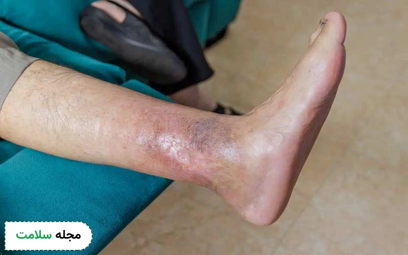 زخم سطحی پای دیابتی بدین شکل است.