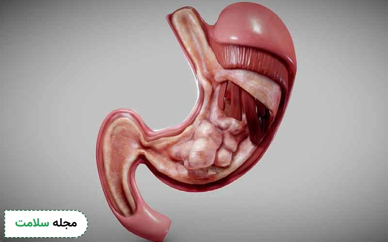 همه‌ چیز درباره سرطان معده خوش خیم
