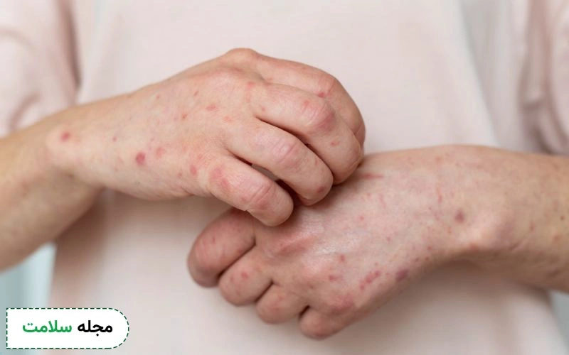 مرحله اول جوش آبله مرغان چیست؟
