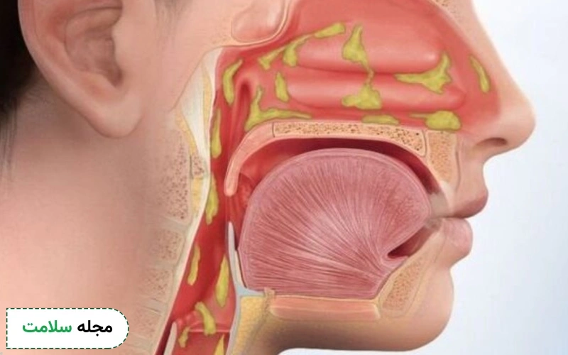 خلط پشت حلق چیست؟