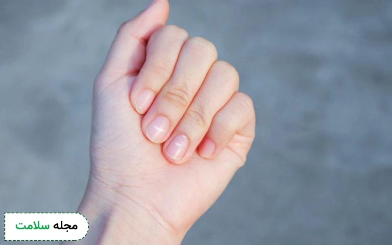 بررسی علل لکه روی ناخن و راه های درمان آن