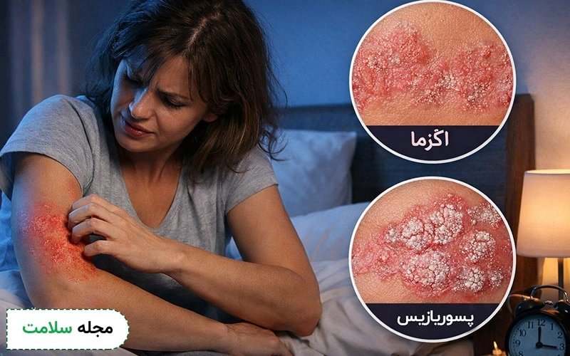 علت خارش بدن در شب همراه با ضایعه پوستی چیست؟