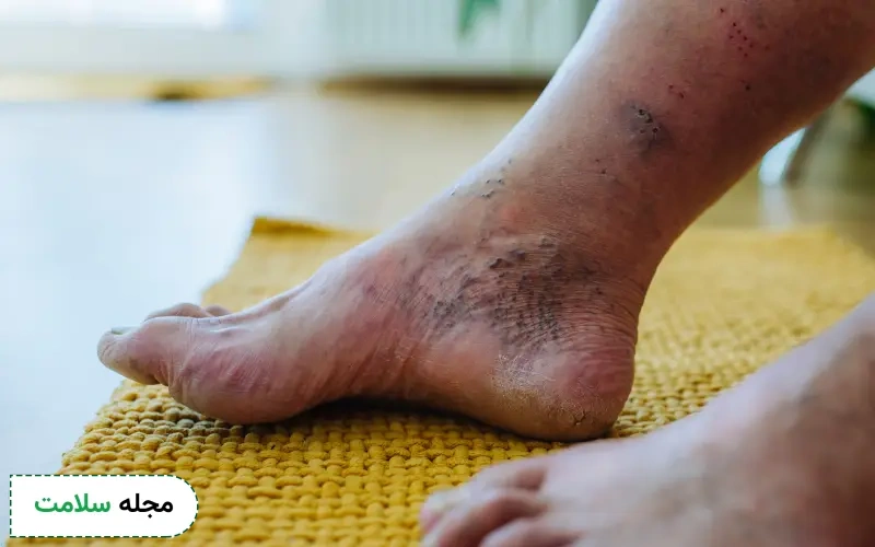 اولین نشانه های شروع زخم پای دیابتی چگونه است؟