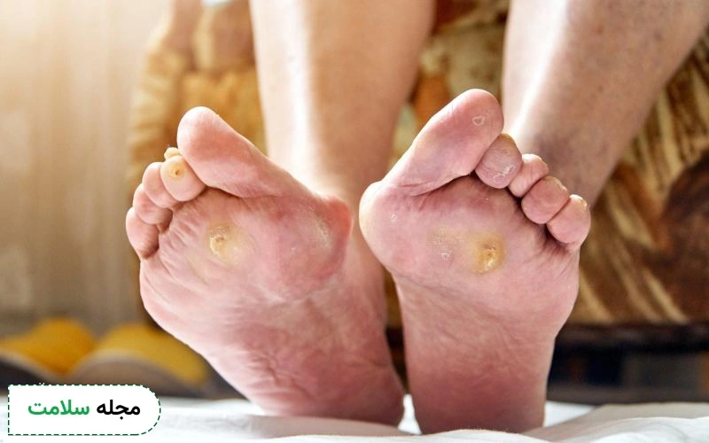 آیا میتوان روی زخم پای دیابتی بتادین زد؟