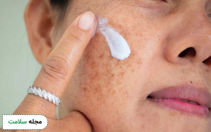 پیشگیری از لک بارداری (ملاسما) چگونه امکانپذیر است؟