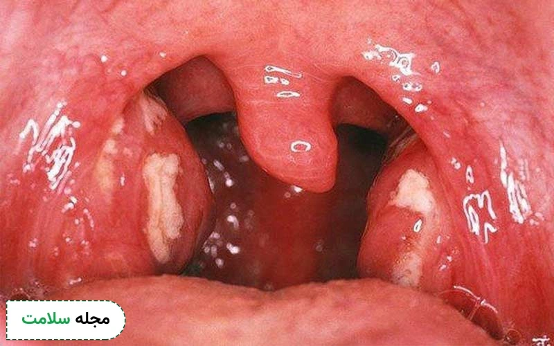 لوزه چرکی معمولاً نتیجه التهاب حاد لوزه است.
