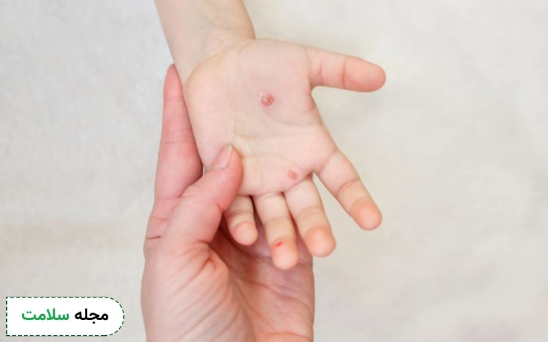 شکل جوشهای ابله مرغان چگونه است؟