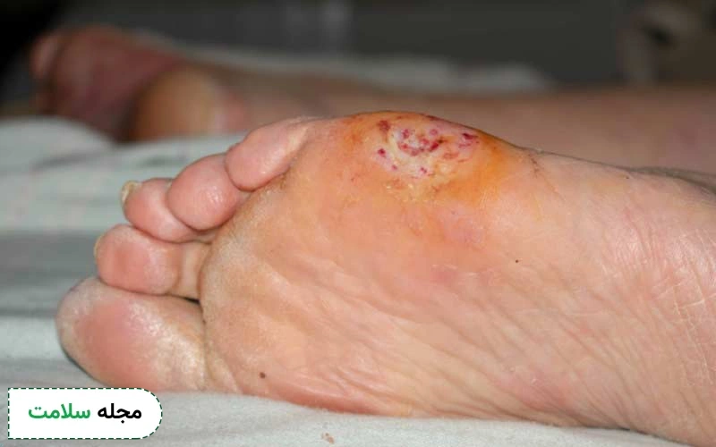 نمای نزدیک از زخم پای دیابتی که از میخچه یا تاول شروع شده است.
