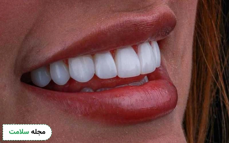 برای طولانی کردن عمر دندان زیرکونیا چگونه باید از آن مراقبت کرد؟