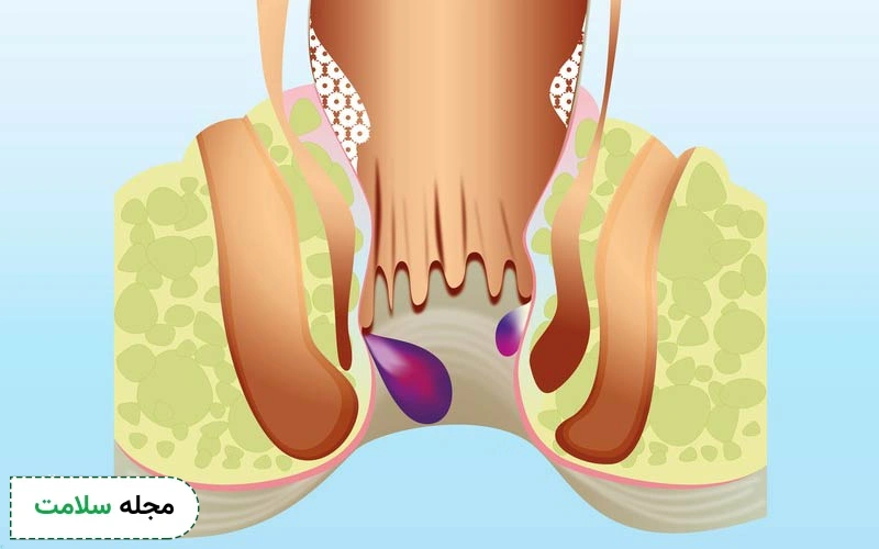 پیشگیری از بواسیر خارجی چگونه امکانپذیر است؟