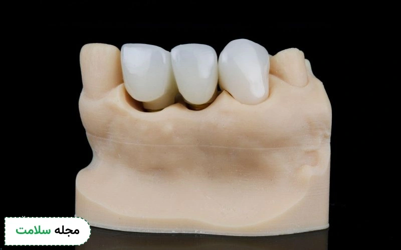 روش اعمال چسب چه تاثیری در عمر روکش دندان دارد؟