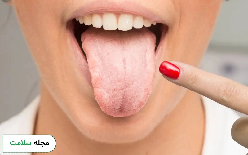 خشکی دهان در بارداری نشانه دیابت است؟