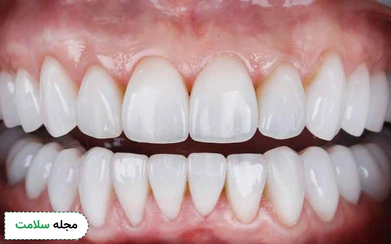 سلامت لثه یکی از عوامل تعیین کننده فاصلی بین عصب کشی و روکش دندان است.