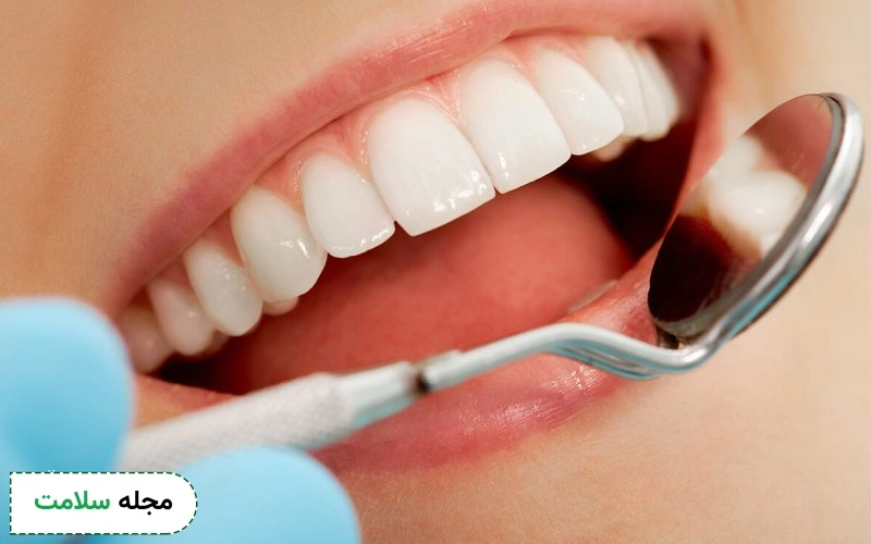 روکش دندان جلو برای چه کسانی مناسب نیست؟