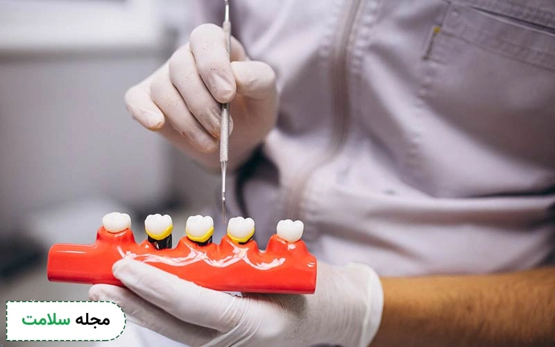 روکش دندان بدون پایه چیست و چه تفاوتی با سایر روکش ها دارد؟