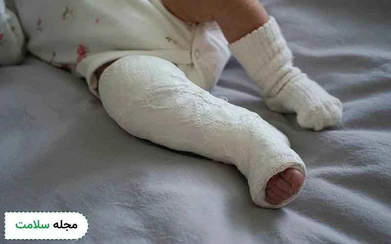 بهترین سن برای درمان پای پرانتزی چه زمانی است؟