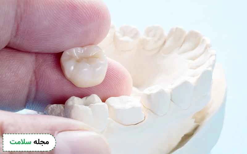 فاصله بین عصب کشی و روکش دندان چقدر است؟