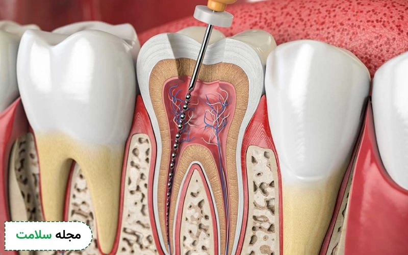 بهترین روکش دندان عصب کشی شده چیست؟