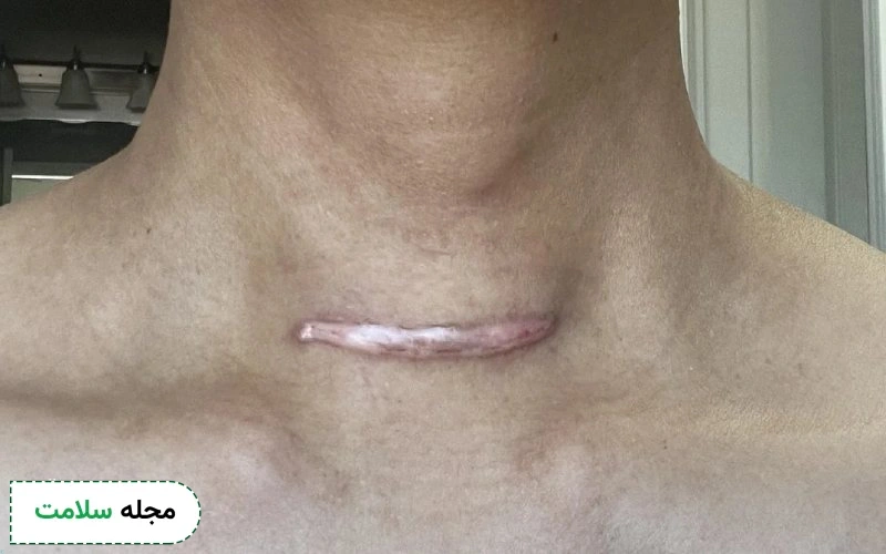 عکس بعد از جراحی تیروئید به چه صورت است؟