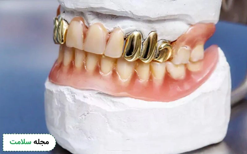 روکش فلزی دندان چیست و چه کاربردی دارد؟