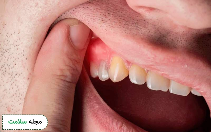 ژل یا دهان‌ شویه ضد التهاب در درمان التهاب موثر هستند.